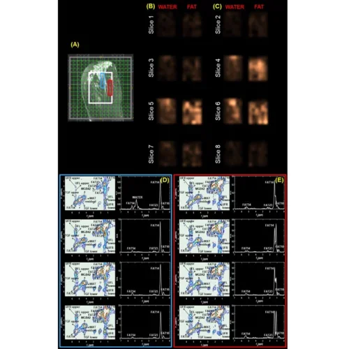 magnetic_resonance_imaging_(mrsi)_of_breast_cancer