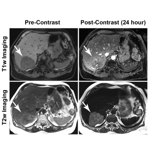 MRI comparison of liver imaging before and after contrast administration.